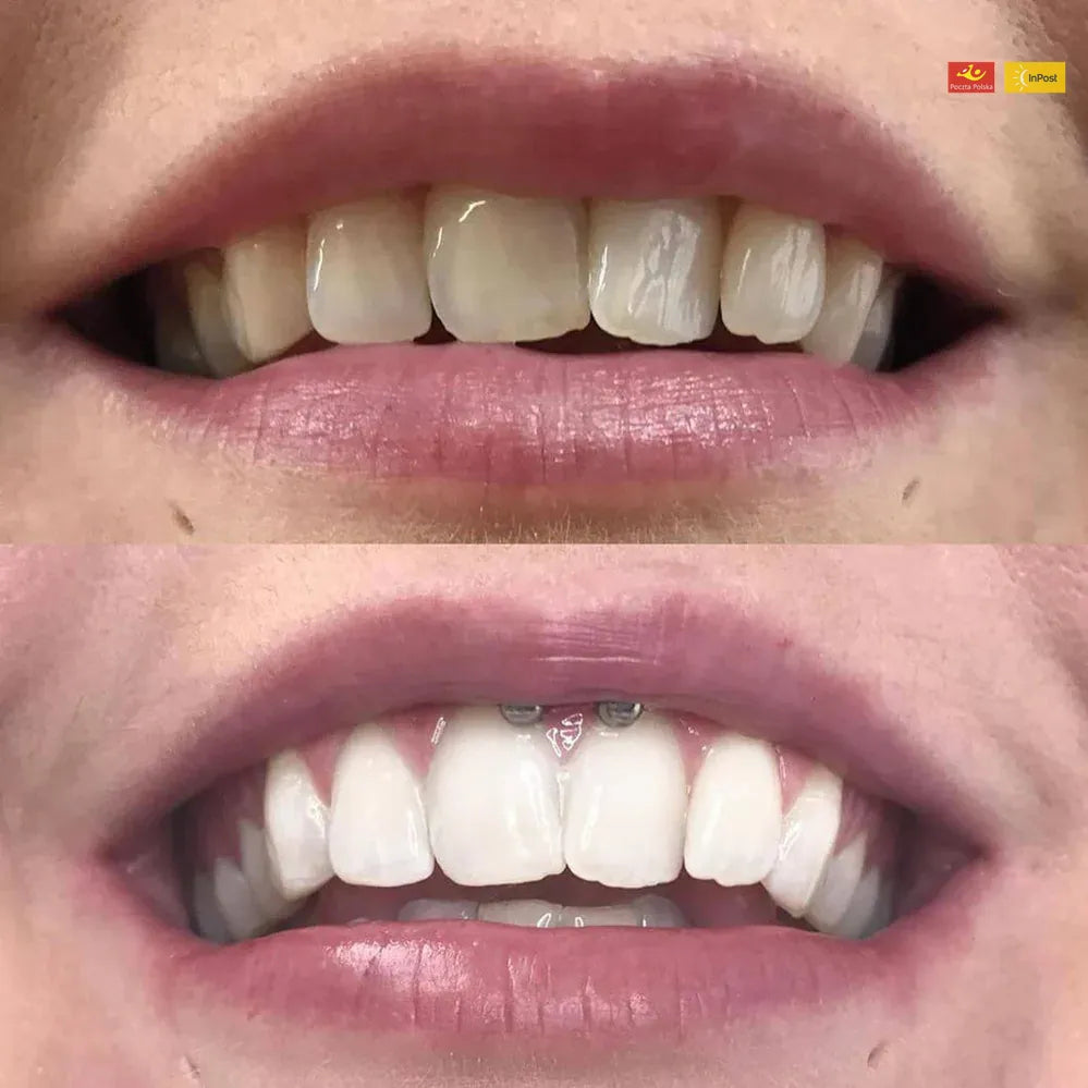 Pióro do wybielania zębów z korektą koloru